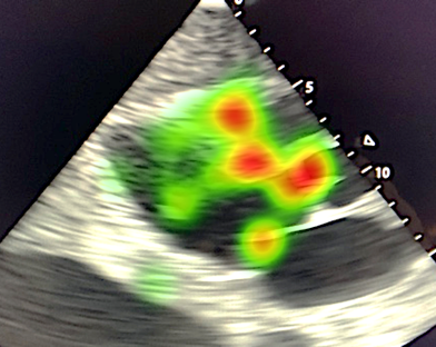 Ultraschallbild des Herzen mit farblich markierten Zonen wie auf einer Heatmap